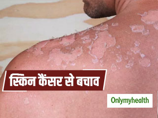 त्‍वचा पर लाल पपड़ीदार घाव है स्किन कैंसर के संकेत, जानें इसके प्रकार और बचाव के तरीके 