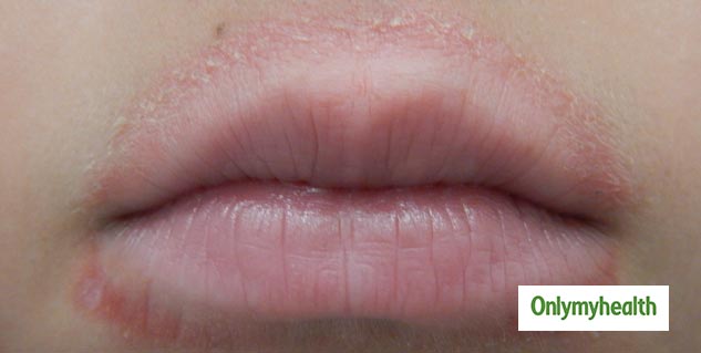 how-to-get-rid-of-dry-skin-around-lips-sitelip