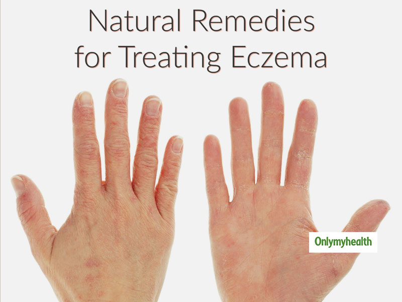 Eczema Home Remedy Treating Eczema Naturally With Echinacea Onlymyhealth 