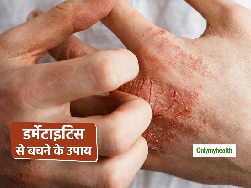 त्वचा पर खुजली, चकत्ते और पपड़ी हैं डर्मेटाइटिस के लक्षण, जानें त्वचा के इंफेक्शन से बचने के घरेलू उपाय