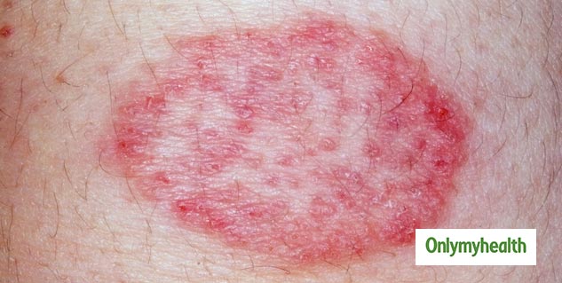 dermetitis