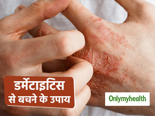 त्वचा पर खुजली, चकत्ते और पपड़ी हैं डर्मेटाइटिस के लक्षण, जानें त्वचा के इंफेक्शन से बचने के घरेलू उपाय