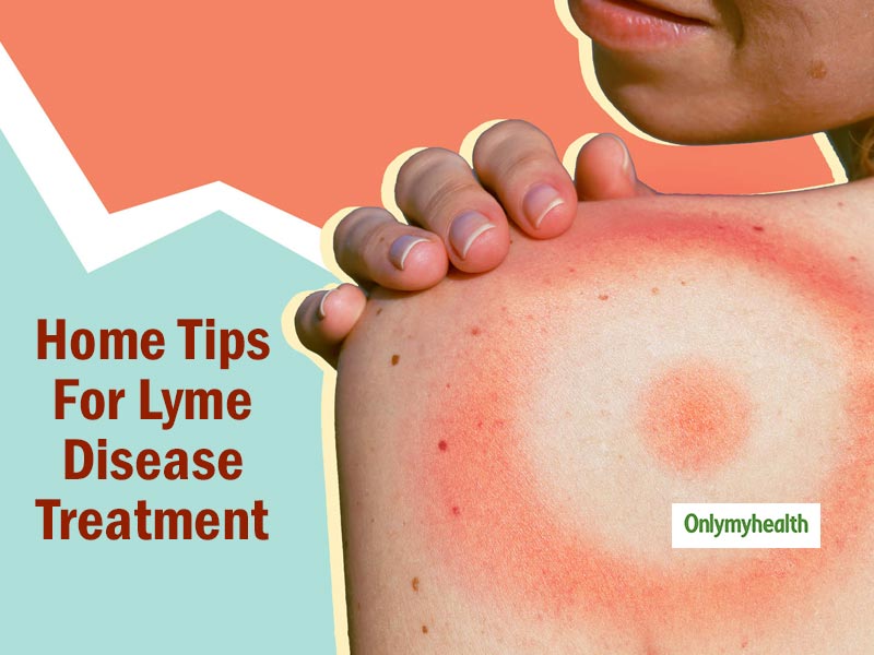 Lyme Disease Home Remedies: These Simple Tips Can Make Healing A Simple ...