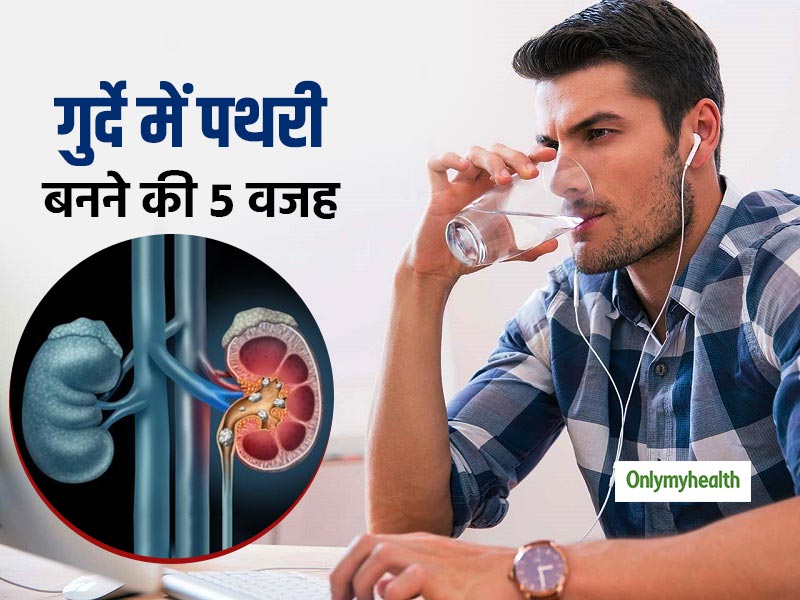 Kidney Stone Causes: गुर्दे में पथरी का कारण बन सकता है पानी न पीना, जानिए क्‍या है पथरी होने की वजह 