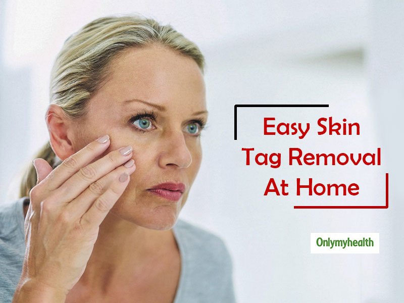 Skin Tags Home Remedies: Here’s How You Can Naturally Remove Skin Tags