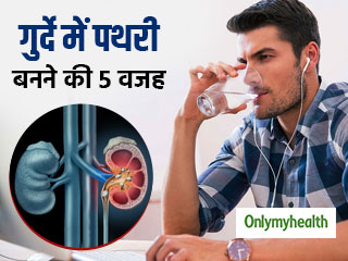 Kidney Stone Causes: गुर्दे में पथरी का कारण बन सकता है पानी न पीना, जानिए क्‍या है पथरी होने की वजह 