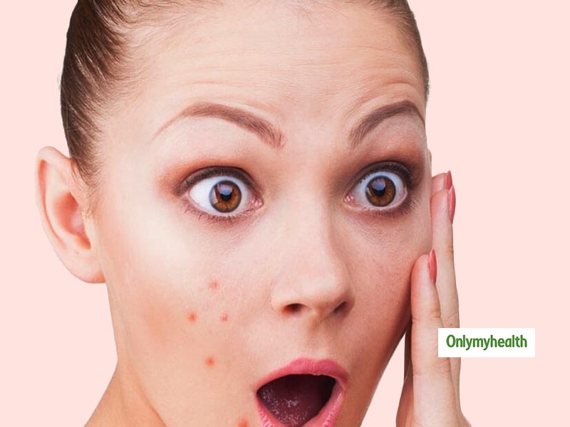 Hormonal Acne: What It Is And How It Can Be Cured