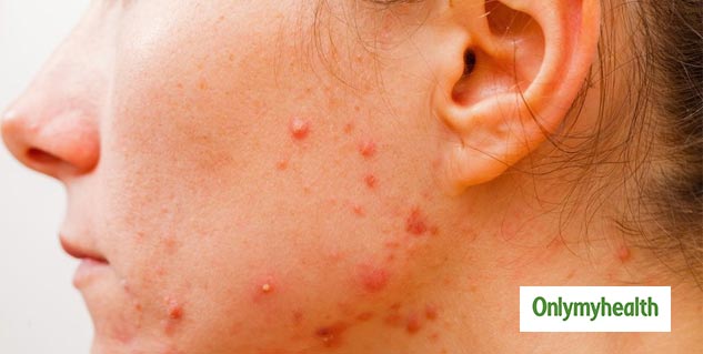 hormonal-acne-what-it-is-and-how-it-can-be-cured-onlymyhealth