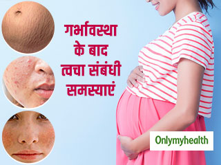 प्रेगनेंसी के बाद स्ट्रेच मार्क्स और त्वचा के धब्बों को मिटायेंगे ये आसान उपाय