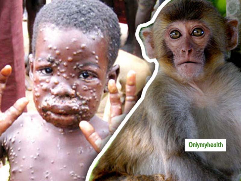 monkeypox virus in Singapore symptoms and treatment guidelines