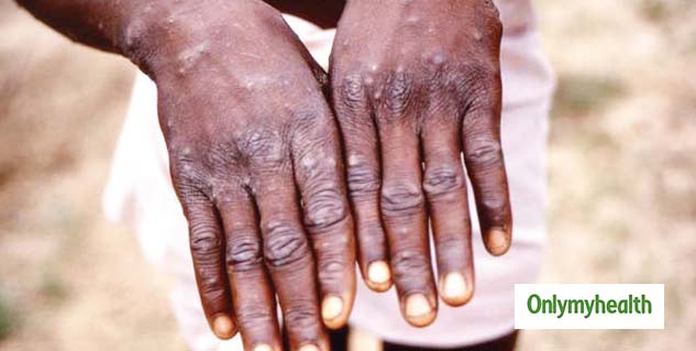 monkeypox virus in Singapore symptoms and treatment guidelines