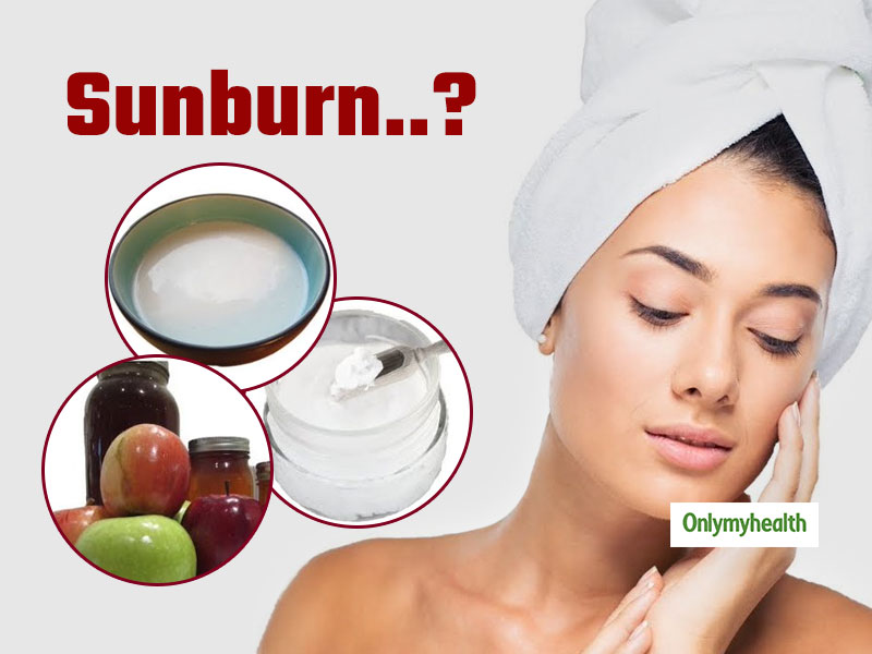 Quick Natural Sunburn Remedies