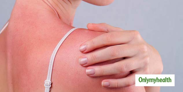 Natural Home Remedies For Sunburn: 6 Best Tips To Cool Down Your