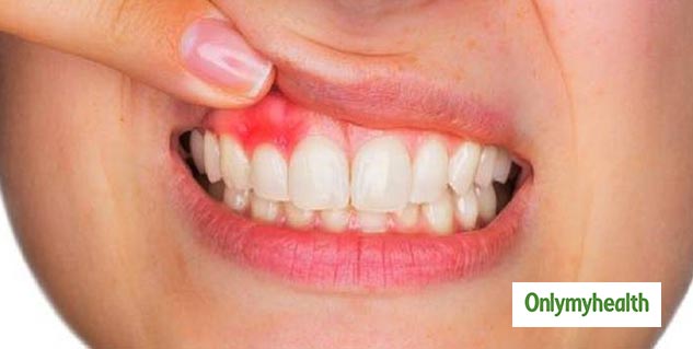 The Main Principles Of Wisdom Teeth Stitches 