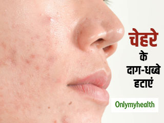 चेहरे पर मुंहासों-दानों से होने वाले दाग-धब्बों को दूर करने के 5 उपाय, पाएं बेदाग त्वचा