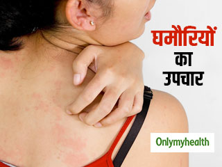 क्‍या आप भी घमौरियों से हैं परेशान? जानें इसके कारण, लक्षण और उपचार 