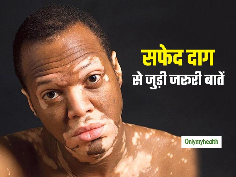 World Vitiligo Day 2020: विटिलिगो (सफेद दाग) क्‍या है, एक्‍सपर्ट से जानिए इसके लक्षण और मनोवैज्ञानिक प्रभाव