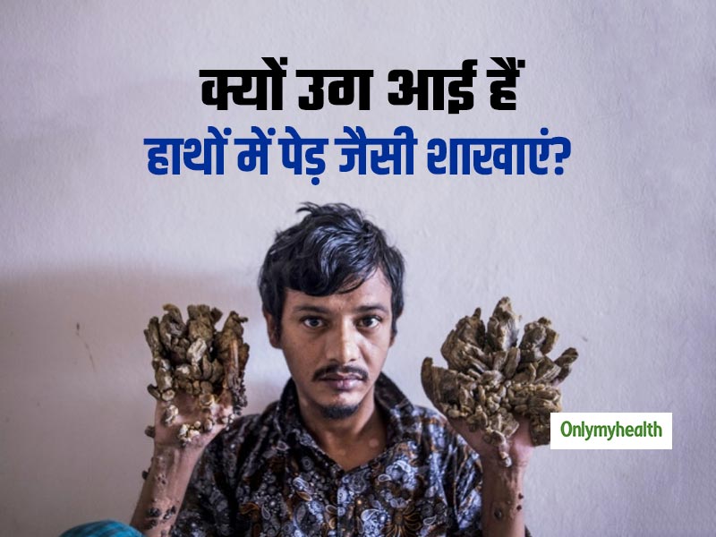 Tree Man Syndrome: इस व्‍यक्ति के हाथ में उग आई हैं पेड़ जैसी शाखाएं, जानें क्‍या है ये बीमारी और कारण 