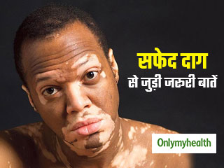 World Vitiligo Day 2020: विटिलिगो (सफेद दाग) क्‍या है, एक्‍सपर्ट से जानिए इसके लक्षण और मनोवैज्ञानिक प्रभाव
