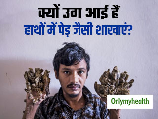 Tree Man Syndrome: इस व्‍यक्ति के हाथ में उग आई हैं पेड़ जैसी शाखाएं, जानें क्‍या है ये बीमारी और कारण 