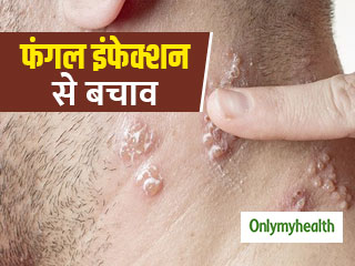 मानसून आने के साथ ही बढ़ जाती हैं इन 5 त्‍वचा रोगों के होने की संभावना, ऐसे करें बचाव 