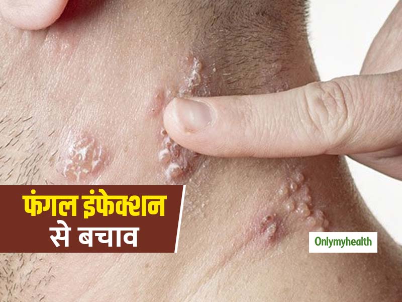 मानसून आने के साथ ही बढ़ जाती हैं इन 5 त्‍वचा रोगों के होने की संभावना, ऐसे करें बचाव 