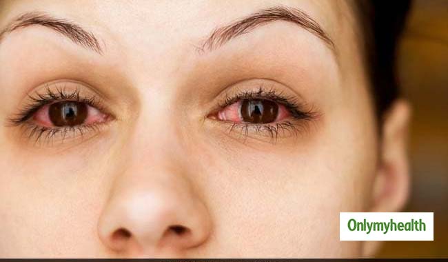आंखों के संक्रमित होने पर इन 6 बातों का रखें ध्यान, मिलेगा जल्दी आराम