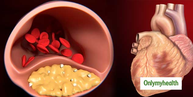 coronary-artery-disease-causes-symptoms-and-prevention-in-hindi