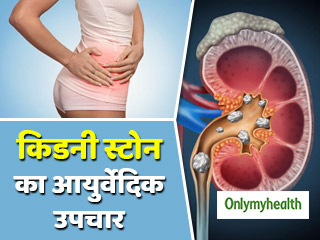 "बिना ऑपरेशन के 9 से 10 mm के किडनी स्‍टोन को आसानी से निकाला जा सकता है" पढ़ें आयुर्वेदिक एक्‍सपर्ट की सलाह
