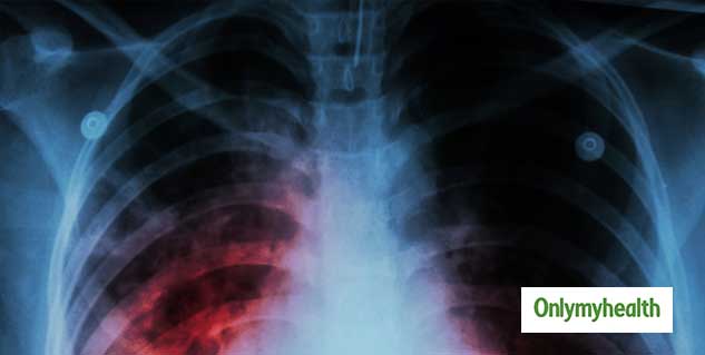 world-tb-day-2022-what-are-the-symptoms-of-tuberculosis-in-hindi