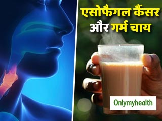लगातार गर्म चाय पीने से होता है एसोफेगल कैंसर का खतरा, पुरुष होते हैं जल्दी प्रभावित