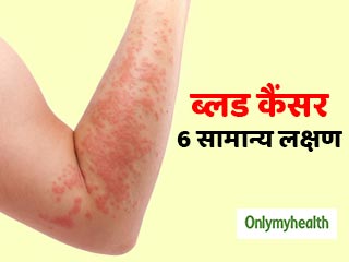 ये 6 संकेत हैं ब्लड कैंसर (खून का कैंसर) के शुरुआती लक्षण, जानें कितना खतरनाक है ये रोग
