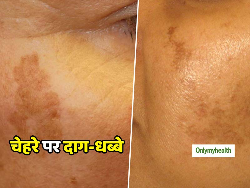 उम्र बढ़ने के साथ चेहरे पर आने वाले दाग-धब्बों यानी 'एज स्पॉट्स' को कैसे छुपाएं?