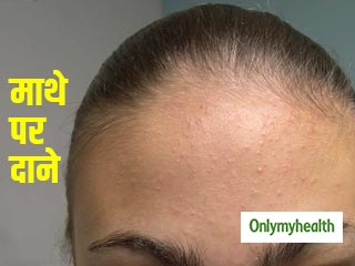 माथे पर होने वाले दानों से पाएं चुटकियों में राहत, आजमाएं ये 4 घरेलू उपाय
