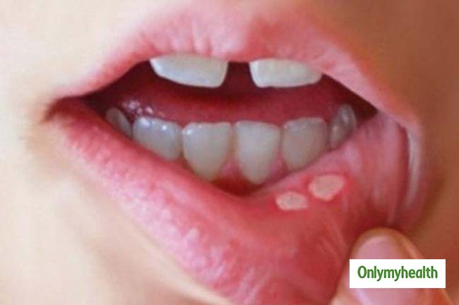 causes-of-recurrent-mouth-ulcers-in-hindi-8