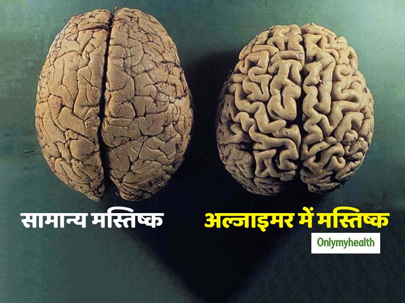 अल्जाइमर रोग: लक्षण दिखने से 34 साल पहले ही शुरू हो जाते हैं मस्तिष्क में परिवर्तन