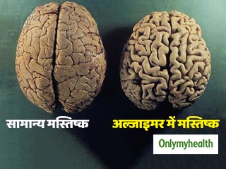 अल्जाइमर रोग: लक्षण दिखने से 34 साल पहले ही शुरू हो जाते हैं मस्तिष्क में परिवर्तन