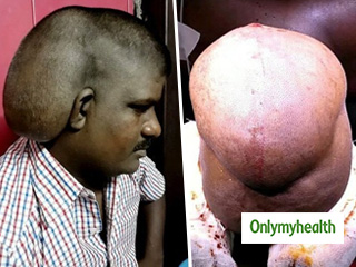 World Brain Tumour Day 2019: दुनिया का सबसे बड़ा ब्रेन ट्यूमर निकालने में भारतीय डॉक्टरों को मिली सफलता, 5 किलो था वजन