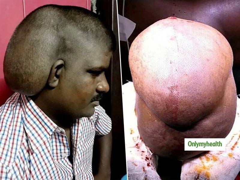 World Brain Tumour Day 2019: दुनिया का सबसे बड़ा ब्रेन ट्यूमर निकालने में भारतीय डॉक्टरों को मिली सफलता, 5 किलो था वजन