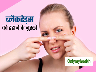 चेहरे के ब्‍लैकहेड्स हटाने के लिए 6 असरदार घरेलू नुस्खे, दाग-धब्‍बों से मिलेगा आसानी से छुटकारा