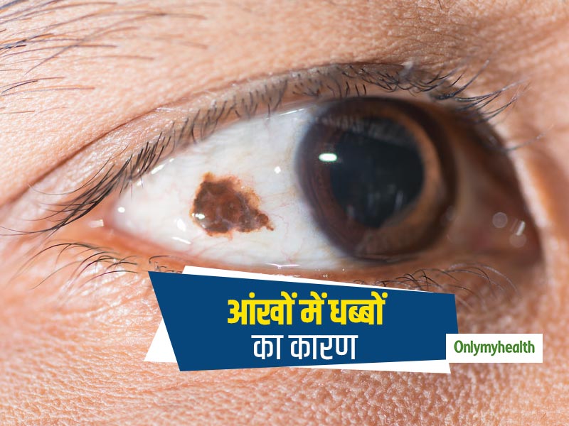 क्या होते हैं आई फ्रेकल्स (आंखों में धब्बे), जानें इसके कारण, खतरे और इलाज के उपाय