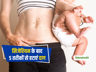 Women's Health : सिजेरियन डिलिवरी के निशान को हटाने के लिए करें ये 5 आसान काम, तेजी से हटेगा दाग
