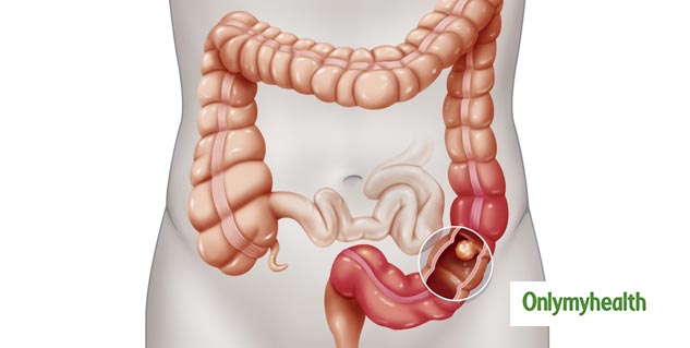 Inside_intestine cancer