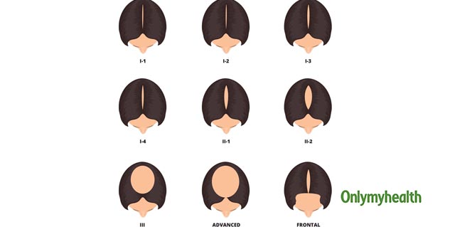 bald patches in women