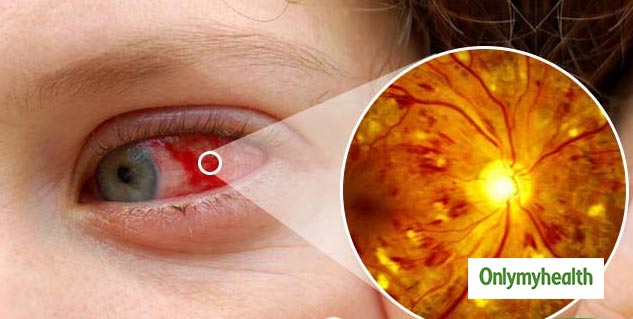 causes of diabeticretinopathy