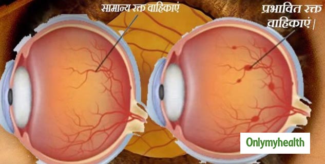 Inside_chart on retinopathy