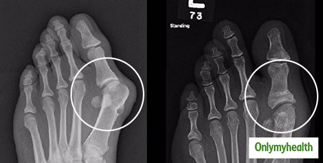 Inside_BUNION X-RAY