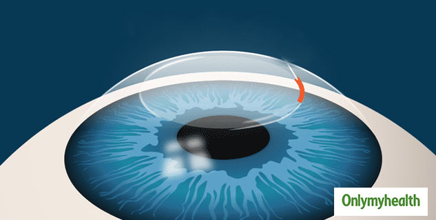 lasik-eye-surgery-procedure