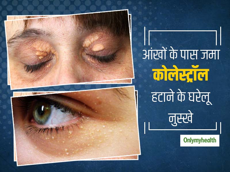 आंखों के साइड में जमे कोलेस्ट्रॉल (पीली पपड़ी जैसी त्वचा) को हटाने के लिए 5 घरेलू उपाय