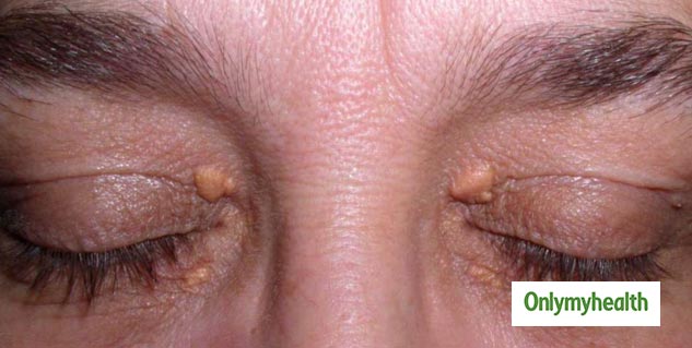 5-home-remedies-to-remove-cholesterol-deposits-around-eyes-xanthelasma